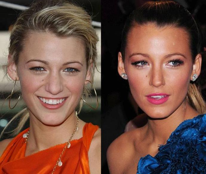 Celebrity a jejich tajné plastiky nosu