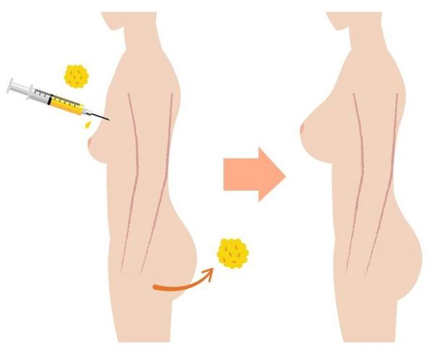 Aesthevita lipostransfer prenos tuku do zadku 27fd9