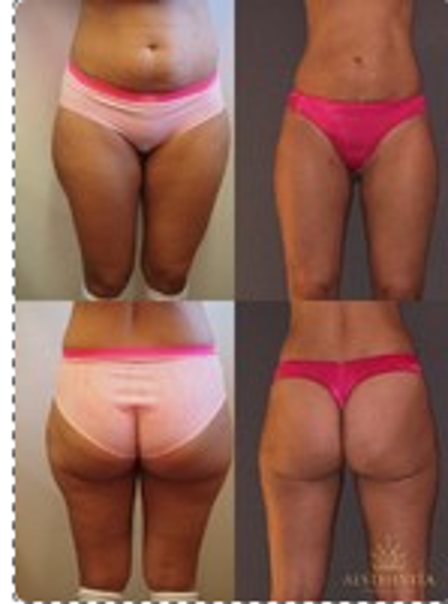 bodytite 2 03ee9