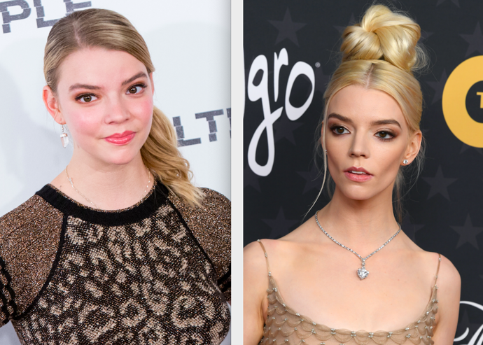 Anya Taylor-Joy

„Jeden z nejvýraznějších zákroků, které podstoupila, je bichectomie, která jí hodně změnila rysy obličeje, dále také výplň lícních kostí. Má za sebou také plastickou operaci nosu, aby působil užší. Znatelný je také browlift, pouze těžko říci, jestli pomocí botulotoxinu nebo nitového liftingu,“ kometuje MUDr. Zuzana Macko
