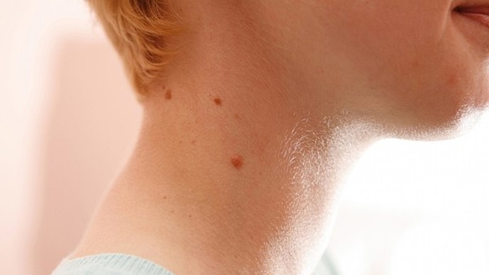 Některé pihy mohou být nebezpečné.