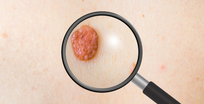 Nechte si zkontrolovat pihy, ať jste připraveni na slunečné počasí.