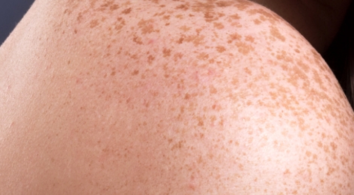 Pihy od sluníčka jsou neškodné.