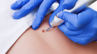 Pihy si můžete nechat odstranit různými způsoby.