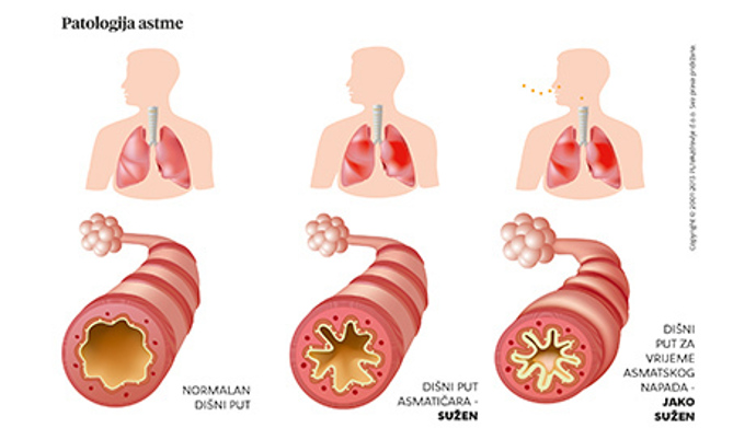 Astmatem trpí 300 milionů lidí na světě