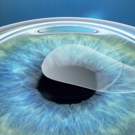 Zahoďte čočky a brýle jednou provždy.