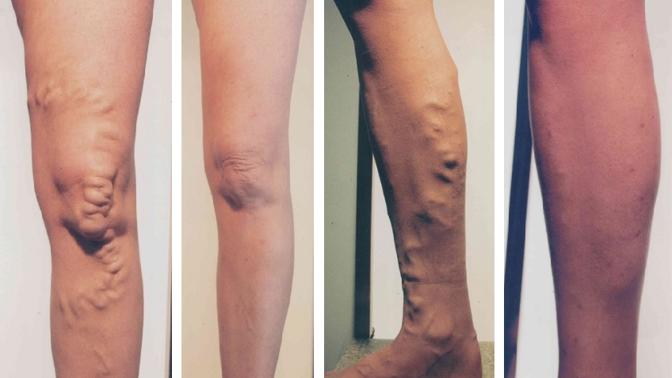 Strašák jménem křečové žíly: Mýty a pravda ohledně prevence i léčby