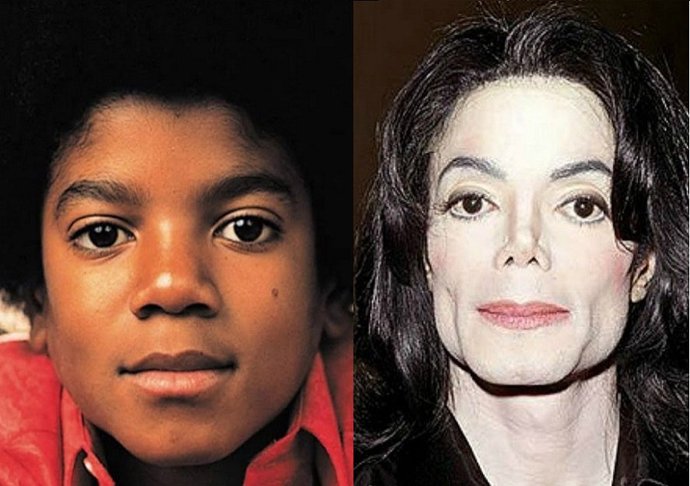 Michael Jackson měnil barvy kůže více než chameleon. Jeho touha stát se bílým mu přivodila velké zdravotní problémy