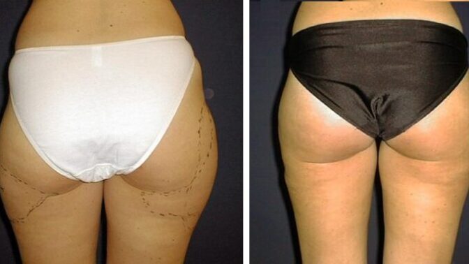 Shoďte kila mávnutím kouzelné hůlky: Liposukce nabízí skvělé výsledky a trvalý efekt