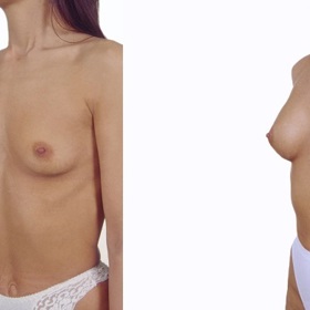 
Stav PŘED a PO zvětšení prsů implantáty