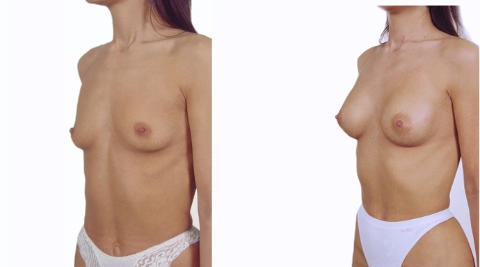 
Stav PŘED a PO zvětšení prsů implantáty