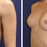 
Stav PŘED a PO augmentaci