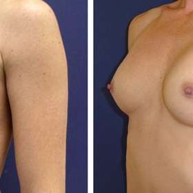 
Stav PŘED a PO augmentaci