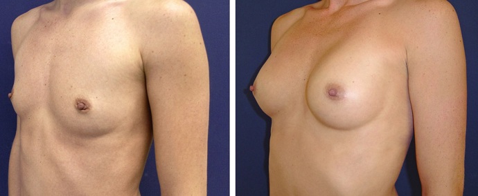 
Stav PŘED a PO augmentaci