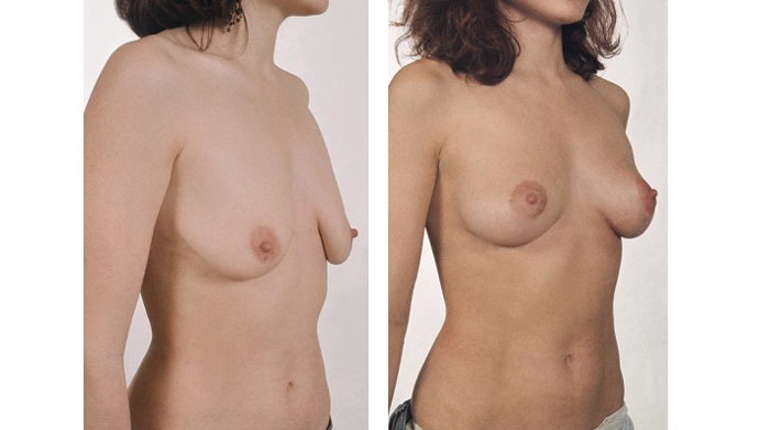 
Stav PŘED a PO modelací prsů