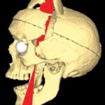 Vědci o několik desetiletí později provedli počítačovou rekonstrukci nehody – takto kovová tyč proťala Cageovu lebku a v horní části vyletěla ven.