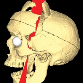 Vědci o několik desetiletí později provedli počítačovou rekonstrukci nehody – takto kovová tyč proťala Cageovu lebku a v horní části vyletěla ven.