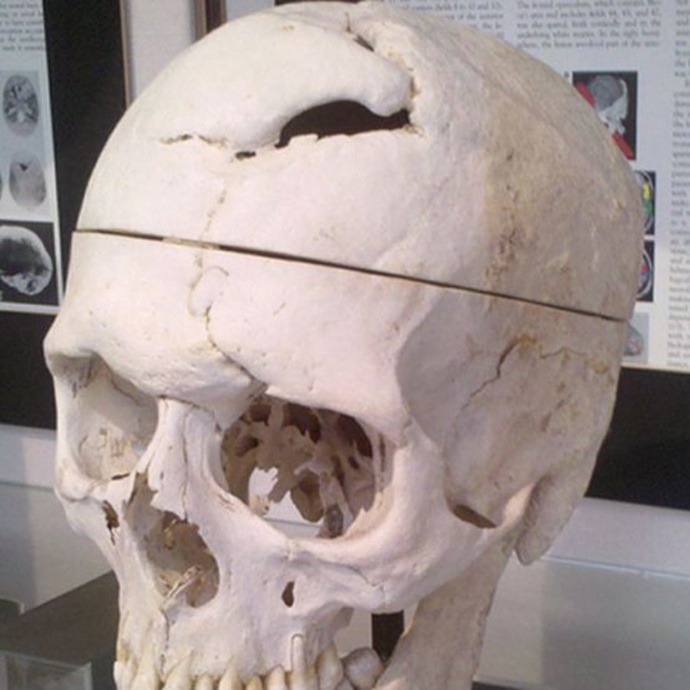 Lebka Phinease Caga, která dokazuje, co všechno může lidské tělo a jeho mozek přežít, je nyní vystavena ve Warrenově anatomickém muzeu.