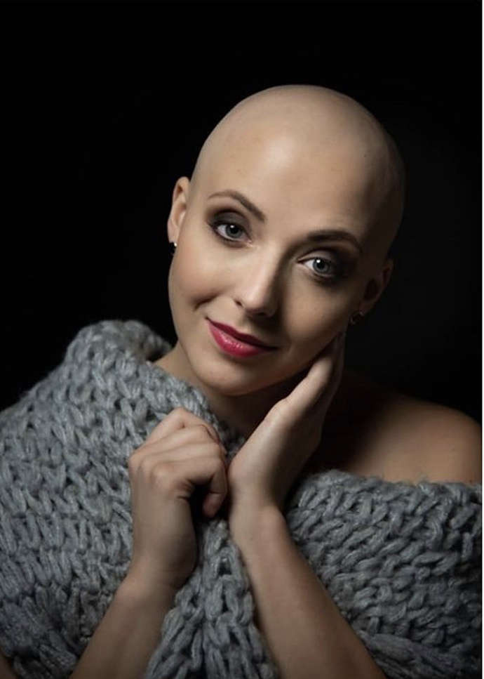 Anička Slováčková po chemoterapiích.