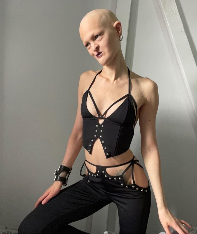 Melanie Gaydos, modelka s ektodermální dysplazií