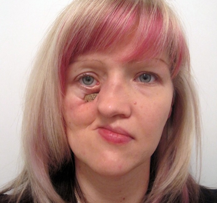 Mirce vzala rakovina část tváře, později se přidaly i další komplikace.