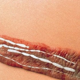 Tasemnicová dieta byla velmi nebezpečná