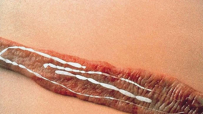 Tasemnicová dieta byla velmi nebezpečná