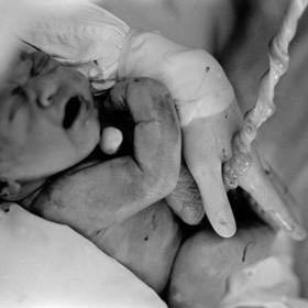 Fotografie pořízena pár minut po narození.
Zdroj: www.jackradcliffe.org