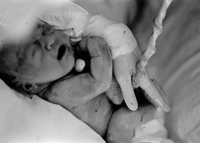 Fotografie pořízena pár minut po narození.
Zdroj: www.jackradcliffe.org