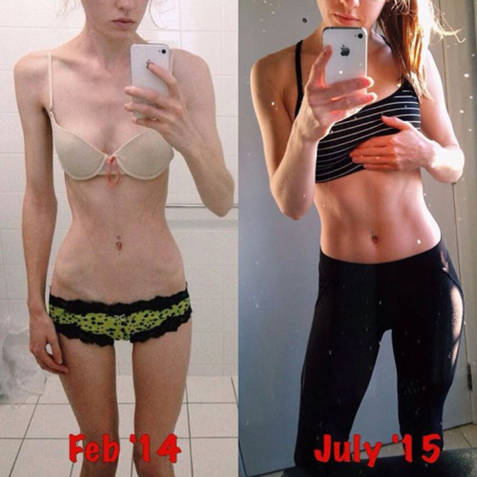 Fenomén „Fit is new skinny“ má jeden hodně pozitivní efekt. Pod taktovkou Kayly Itsines a jiných trenérů se totiž do formy dostávají i ženy a dívky trpící anorexií. Na jejich srovnávací fotografie před a po nabrání nezbytných tuků a svalové hmoty je snad ještě lepší pohled než na holky, co řešily opačný problém. Navíc díky hromadnému sdílení mohou motivovat další dívky, které trpí poruchou příjmu potravy.
Zdroj: Instagram Kayly Itsines