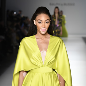 Winnie Harlow: vitiligo

Winnie Harlow je jednou z neznámějších osob trpící nemocí zvanou vitiligo, která způsobuje ztrátu barvy kůže v podobě skvrn. Nemoc se u ní objevila už ve čtyřech letech. Namísto toho, aby vitiligo skvrny skrývala například pomocí make-upu, se snaží zvyšovat povědomí o této nemoci. Zároveň má svou řadu slunečních krémů pro všechny odstíny pleti.
