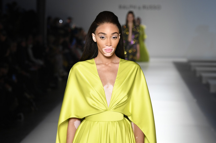 Winnie Harlow: vitiligo

Winnie Harlow je jednou z neznámějších osob trpící nemocí zvanou vitiligo, která způsobuje ztrátu barvy kůže v podobě skvrn. Nemoc se u ní objevila už ve čtyřech letech. Namísto toho, aby vitiligo skvrny skrývala například pomocí make-upu, se snaží zvyšovat povědomí o této nemoci. Zároveň má svou řadu slunečních krémů pro všechny odstíny pleti.

