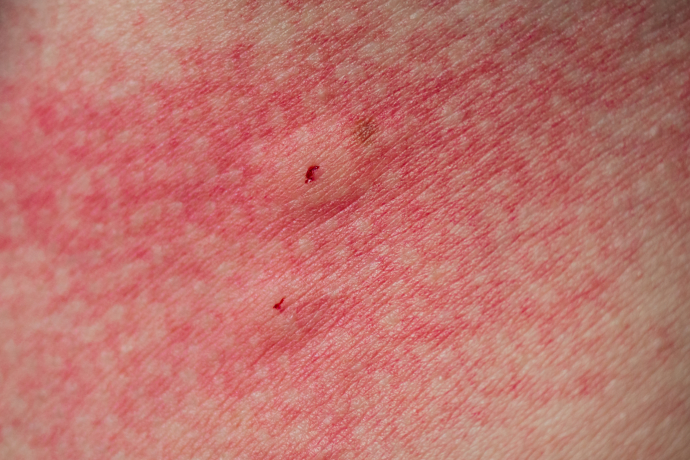 Dvě tečky vedle sebe jsou památkou na pavoučí kusadla. Místo obvykle pálí a je teplé na dotek
Dvě tečky vedle sebe jsou památkou na pavoučí kusadla. Místo obvykle pálí a je teplé na dotek