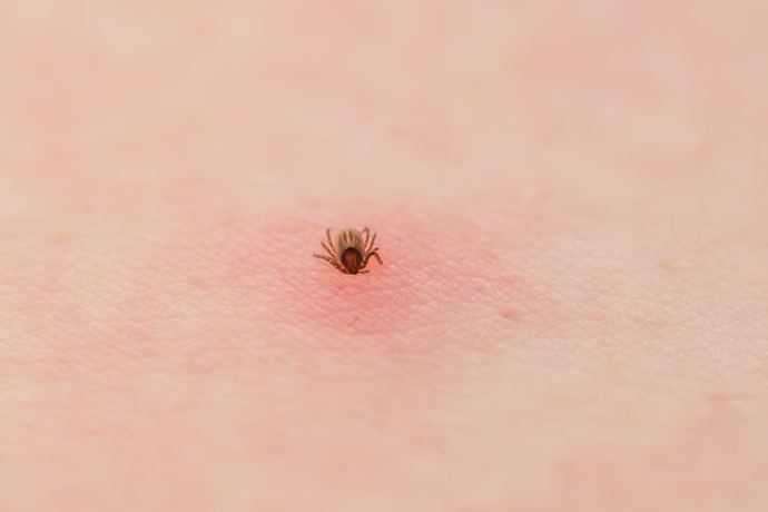 Klíště vydrží zakousnuté i několik dní. Pokud samo odpadne, je jasná ranka od kousnutí, kulatě ohraničená, oteklá a zarudlá
Klíště vydrží zakousnuté i několik dní. Pokud samo odpadne, je jasná ranka od kousnutí, kulatě ohraničená, oteklá a zarudlá