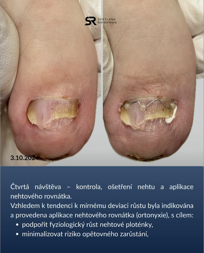 Rovnátka někdy mohou předejít chirurgickému zákroku, po němž je mnohem delší rekonvalescence.
