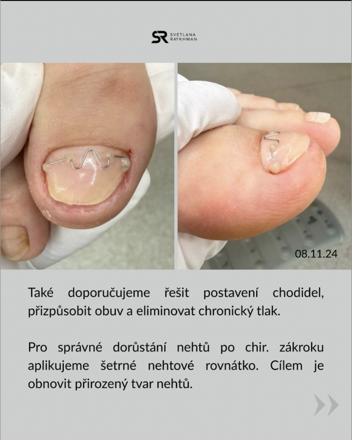 Špatně rostoucí a poškozený nehet působí bolest i v botě.
