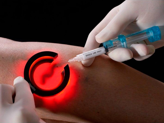 Operace křečových žil nemusí být strašák Operace křečových žil nemusí být strašák