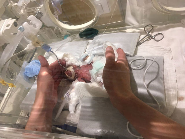 Vešel se do dlaně, dnes už váží přes 3 kg! Dojemný příběh nejmenšího miminka na světě Vešel se do dlaně, dnes už váží přes 3 kg! Dojemný příběh nejmenšího miminka na světě
