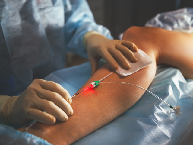Ošetření cév doprovodnou laserovou diodou Ošetření cév doprovodnou laserovou diodou