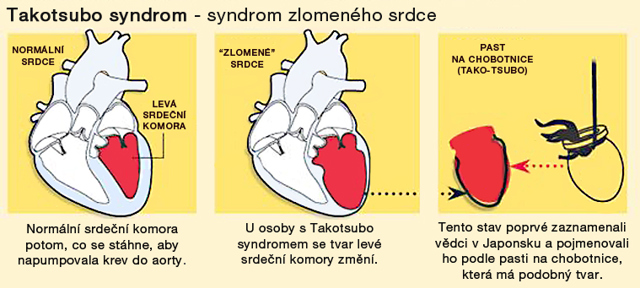 Můžete zemřít na zlomené srdce?