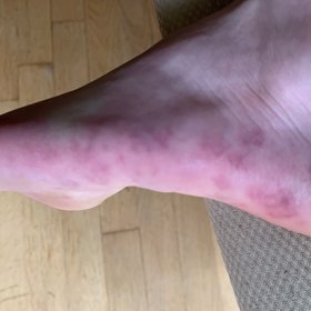 Při nákaze se mohou objevit na nohách skvrny.