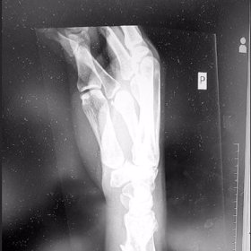 Rentgen zlomeného zápěstí.