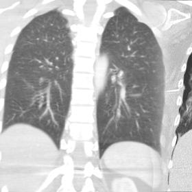 Levé plíce patří zdravému člověku, pravé pacientovi s koronavirem.