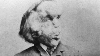 Joseph Merrick alias sloní muž: Milovaná maminka mu zemřela v 11 letech, jako zvíře vystupoval v cirkuse