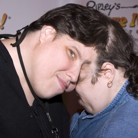 Siamská dvojčata Lori a George Schappellovi.