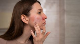 Růžovka čili rosacea: Boji s nepříjemným onemocněním kůže obličeje pomůže dermokosmetika