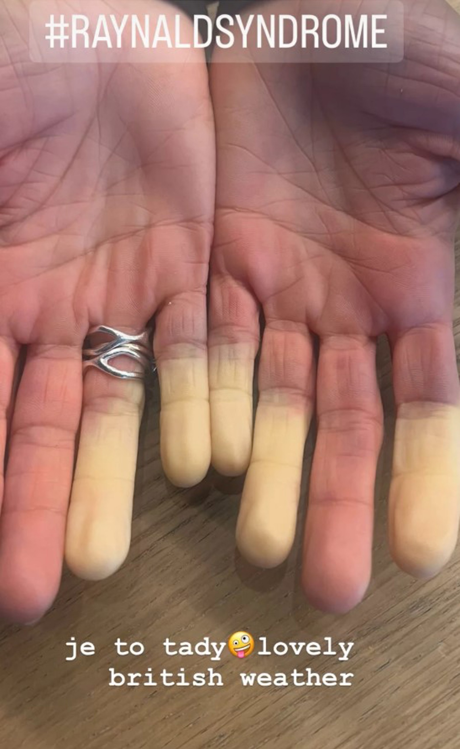 Prsty Na Ruce Galerie: Ivana Jirešová trpí raynaudovým syndromem: Prsty na rukou se ...