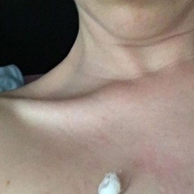 Soňa Porupková si musela nechat vyříznout znaménko v dekoltu společně s kusem kůže.