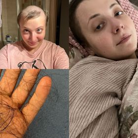 Anička Slováčková už ztrátu vlasů příliš neprožívá. 