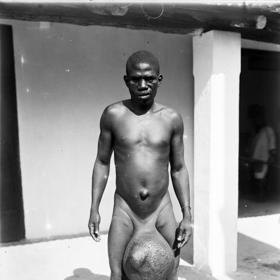 I takto může vypadat elefantiáza. V tomto případě postižený trpí nadměrně zvětšenými varlaty.